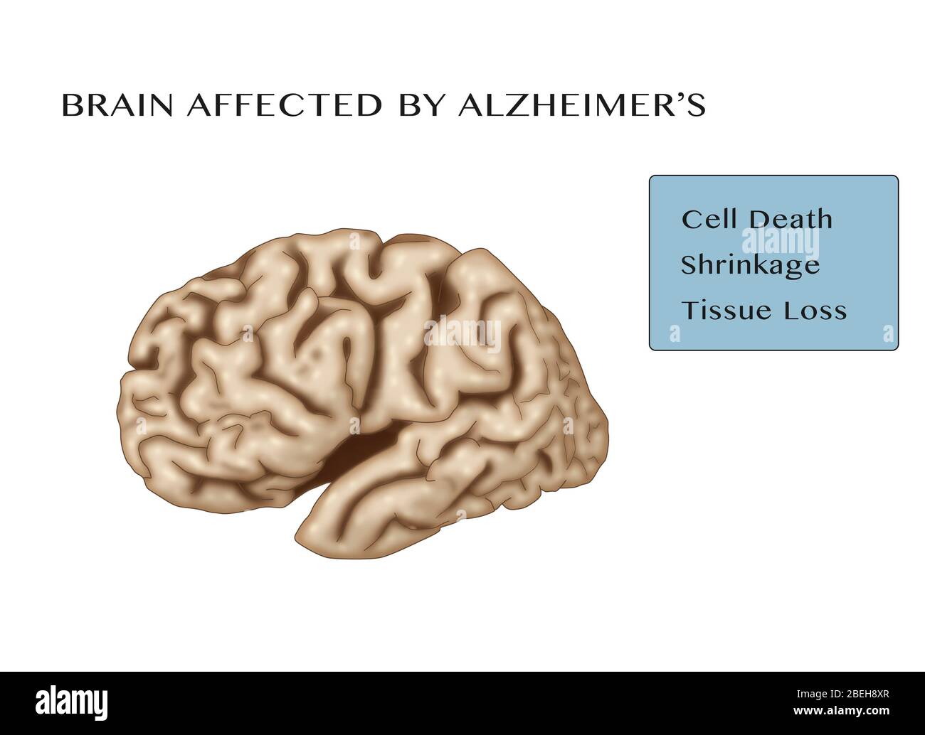 Brain Affected by Alzheimer's Disease Stock Photo - Alamy