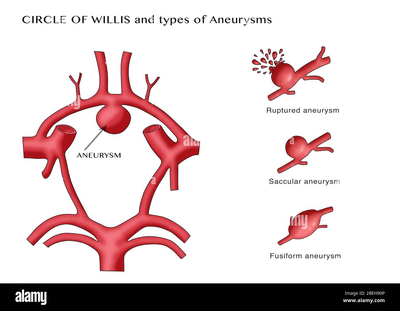 Aneurysm in the Circle of Willis Stock Photo