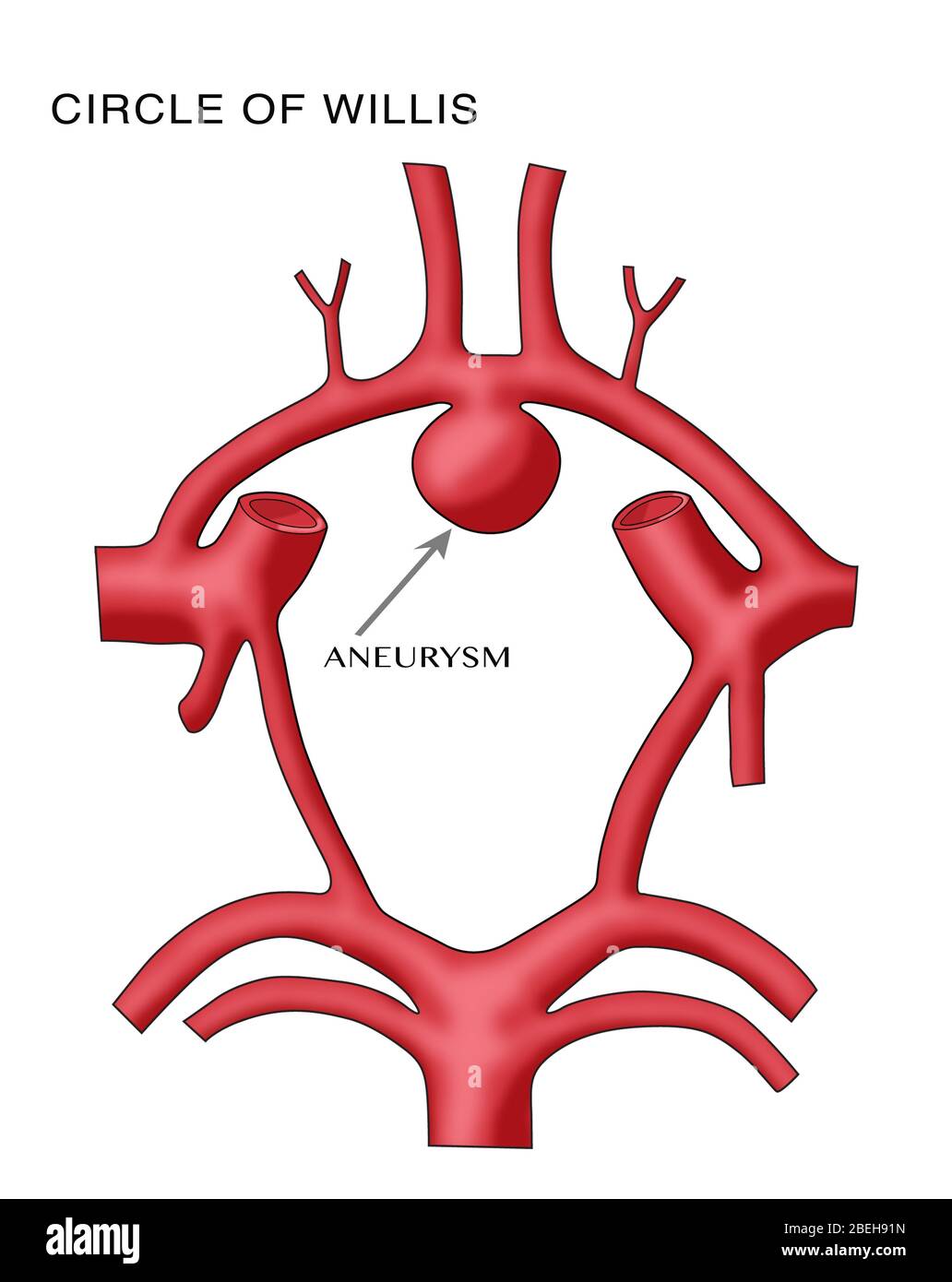 Aneurysm in the Circle of Willis Stock Photo