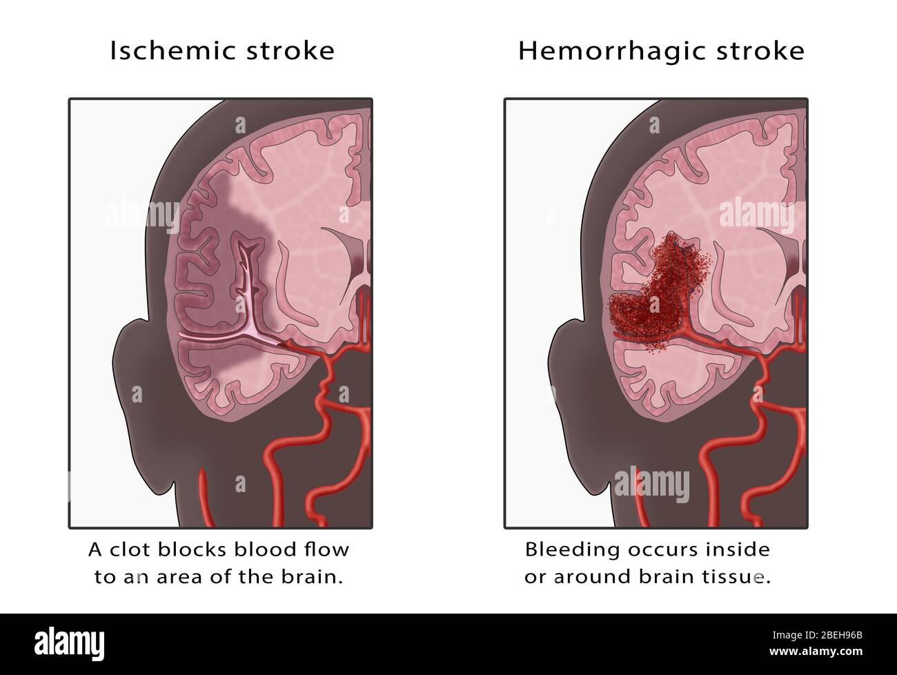 Effects of Stroke - Milka Clarke Stroke Brain Trauma Foundation