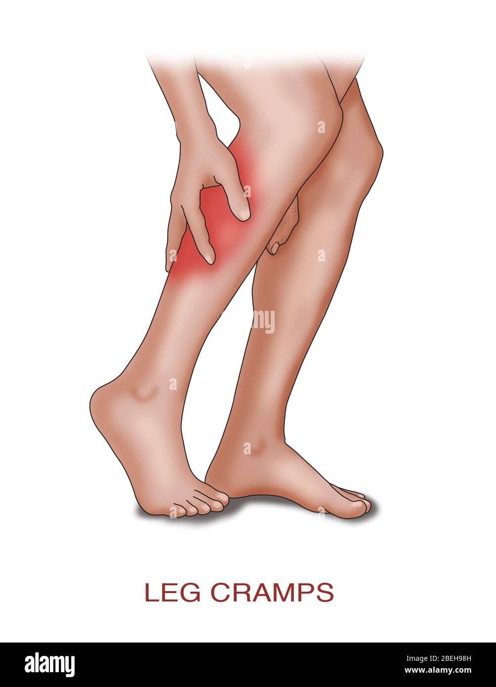 Leg Cramp Common Causes, Illustration Stock Photo Alamy