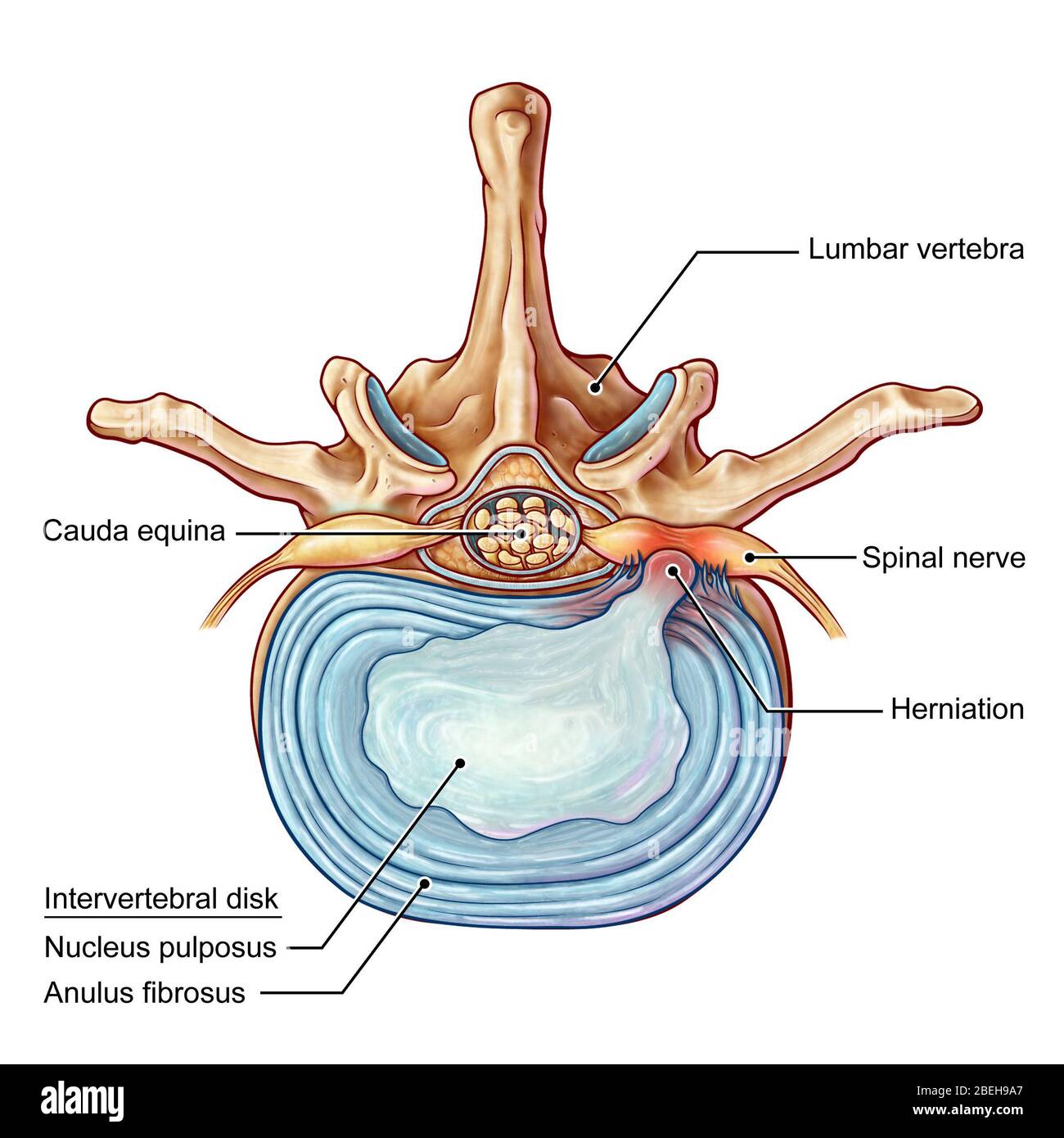 An illustration of a posterolateral herniation of an intervertebral disk in the lumbar spine.  Individuals suffer from a herniated disk when the outer fibrous tissue of the disk, known as the anulus fibrosus, can rupture due to trauma or old age.  As a result, the gel-like center of the disk protrudes outward and compresses the nerves in the back, weakening muscles and causing severe local back pain. Stock Photo