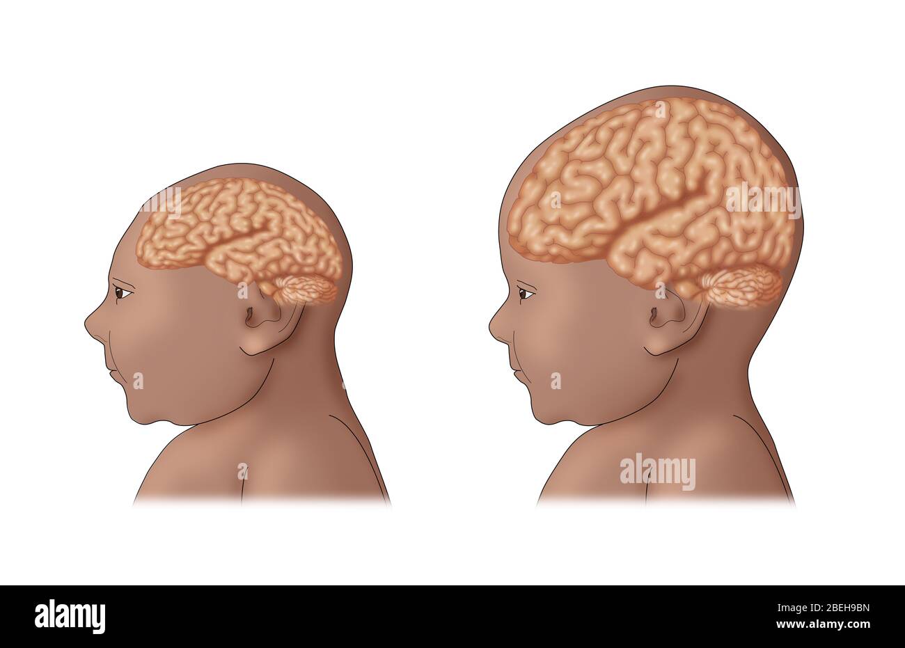 Microcephaly, Illustration Stock Photo