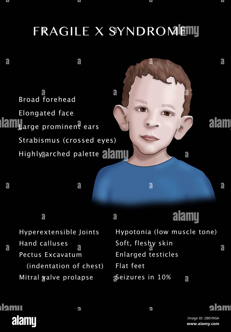 Fragile X Syndrome Characteristics