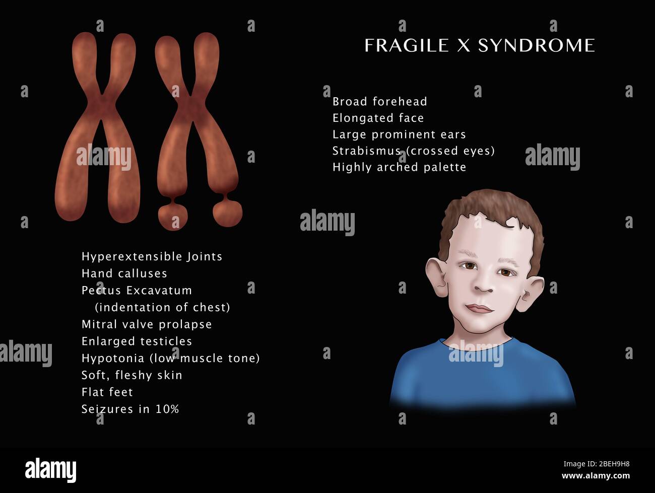 Fragile X Syndrome Testicles
