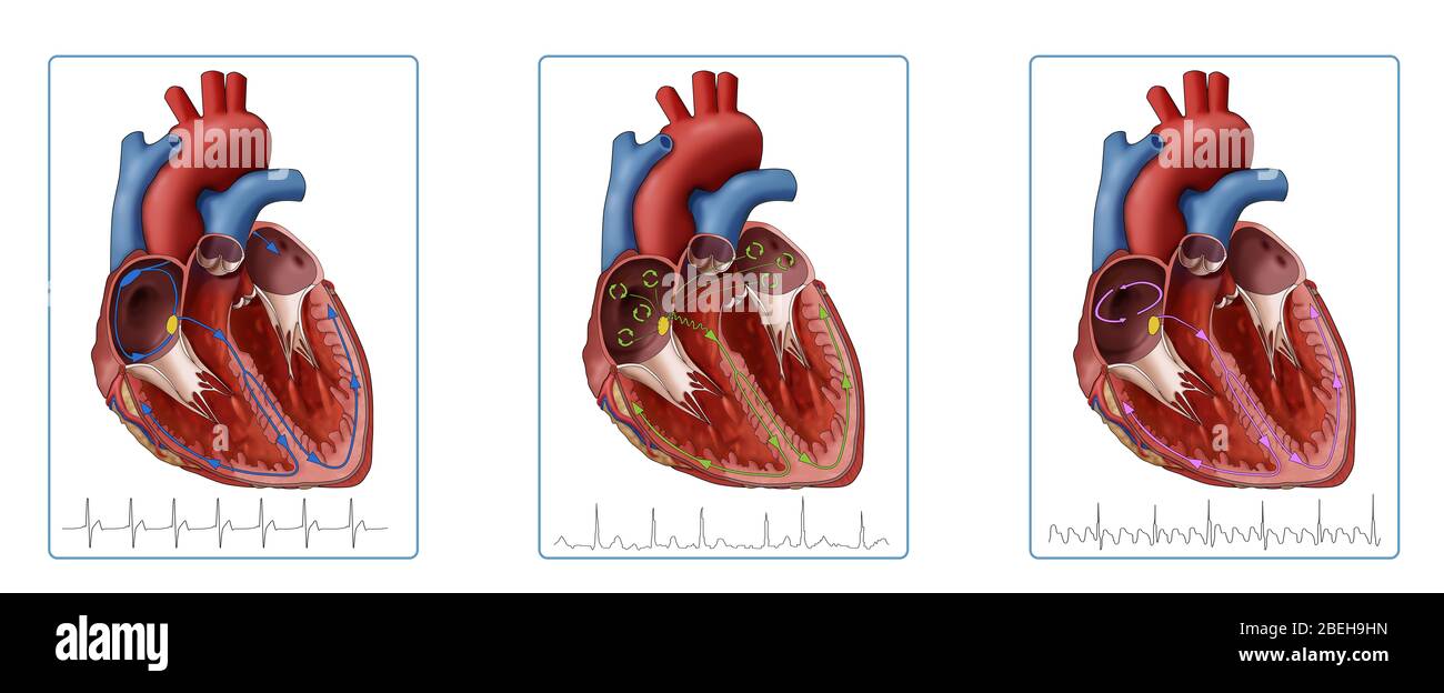 Heart, AFib and Atrial Flutter, Illustration Stock Photo