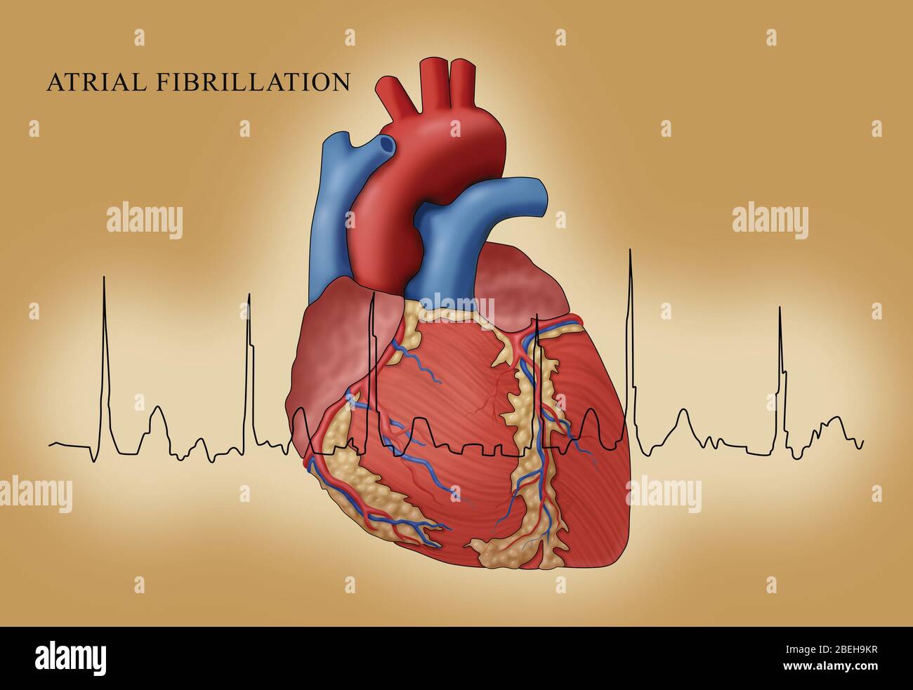 Atrial Fibrillation with EKG, Illustration Stock Photo