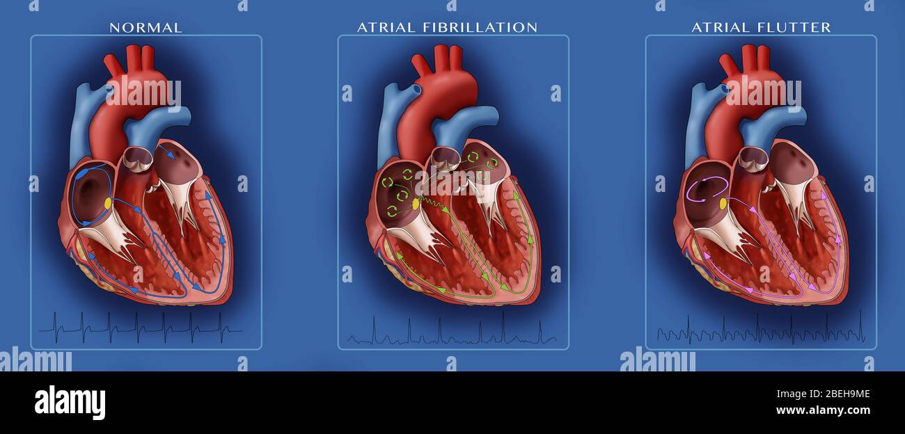 atrial fibrillation vs atrial flutter
