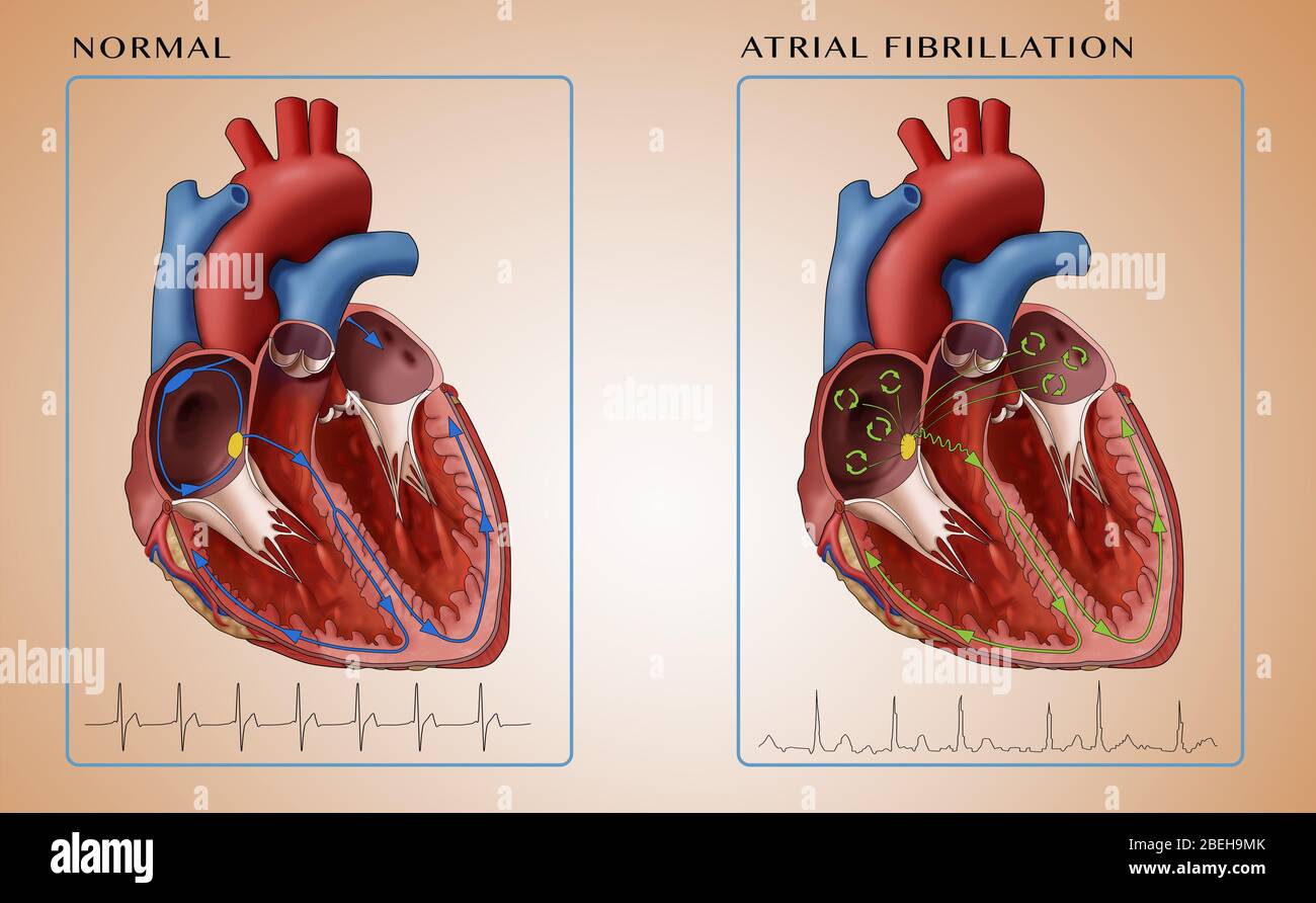 Heart, Atrial Fibrillation and EKGs, Illustration Stock Photo
