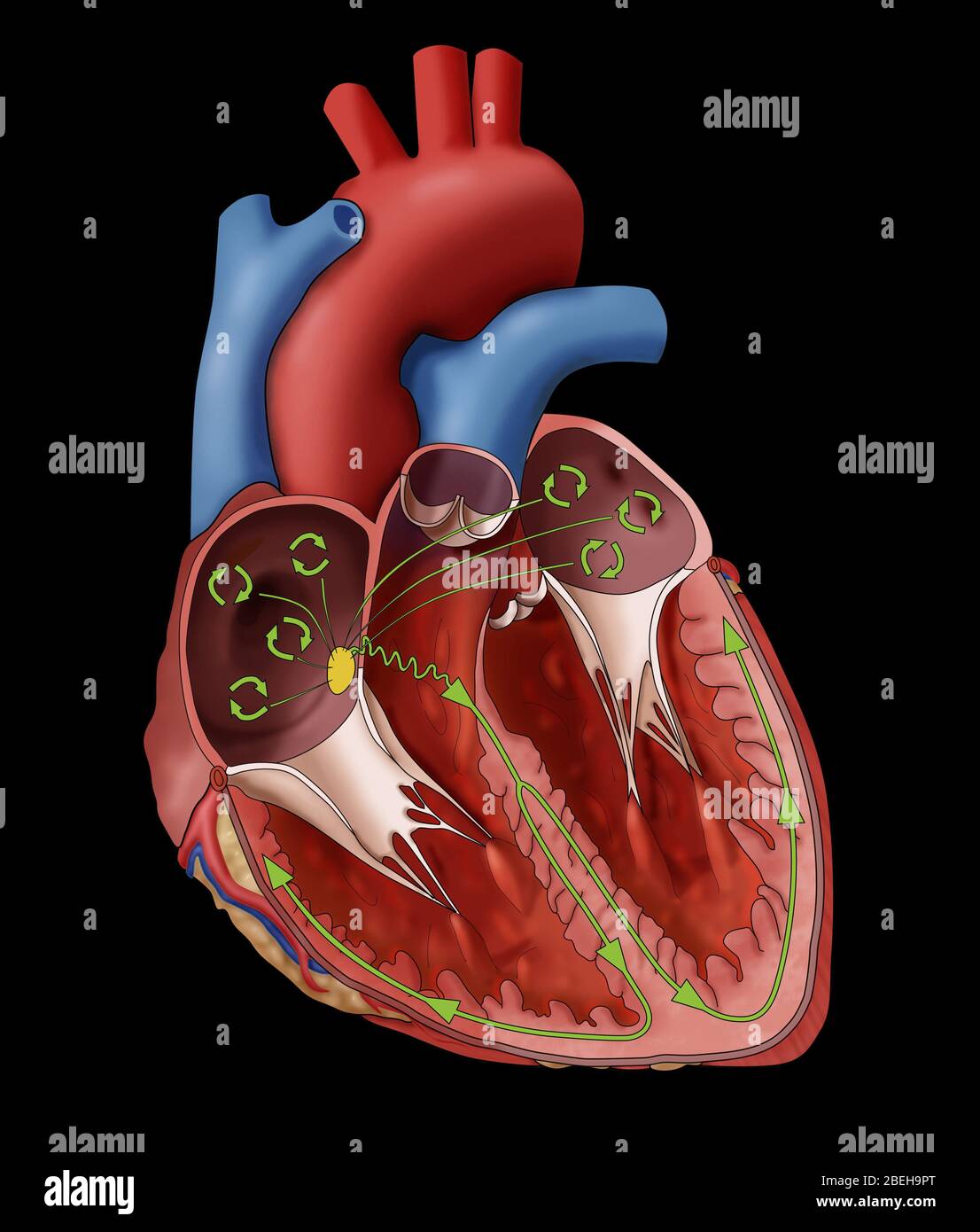 Illustration showing a heart with atrial fibrillation (AFib), a heart rhythm abnormality. As shown here, the electrical impulses (green circles) are spread through the atria in a chaotic fashion causing the heart to beat in a rapid disorganized manner. Stock Photo