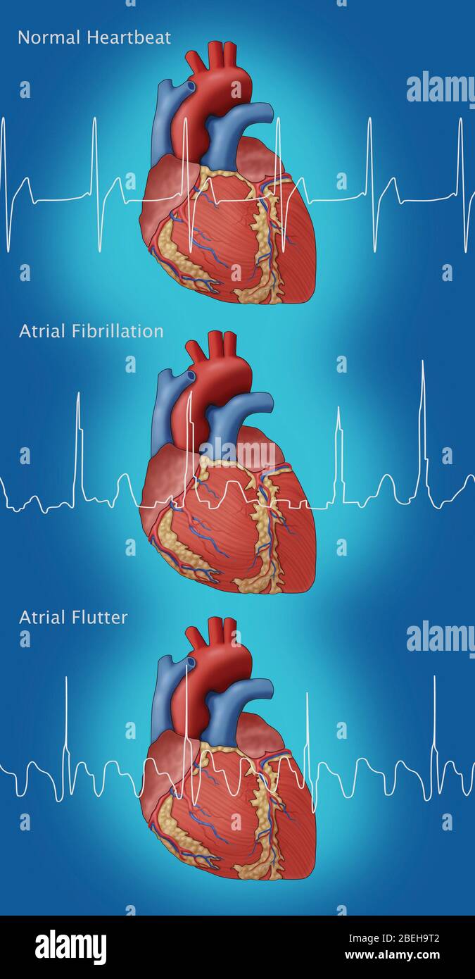 Heartbeat, AFib and Atrial Flutter, Illustration Stock Photo