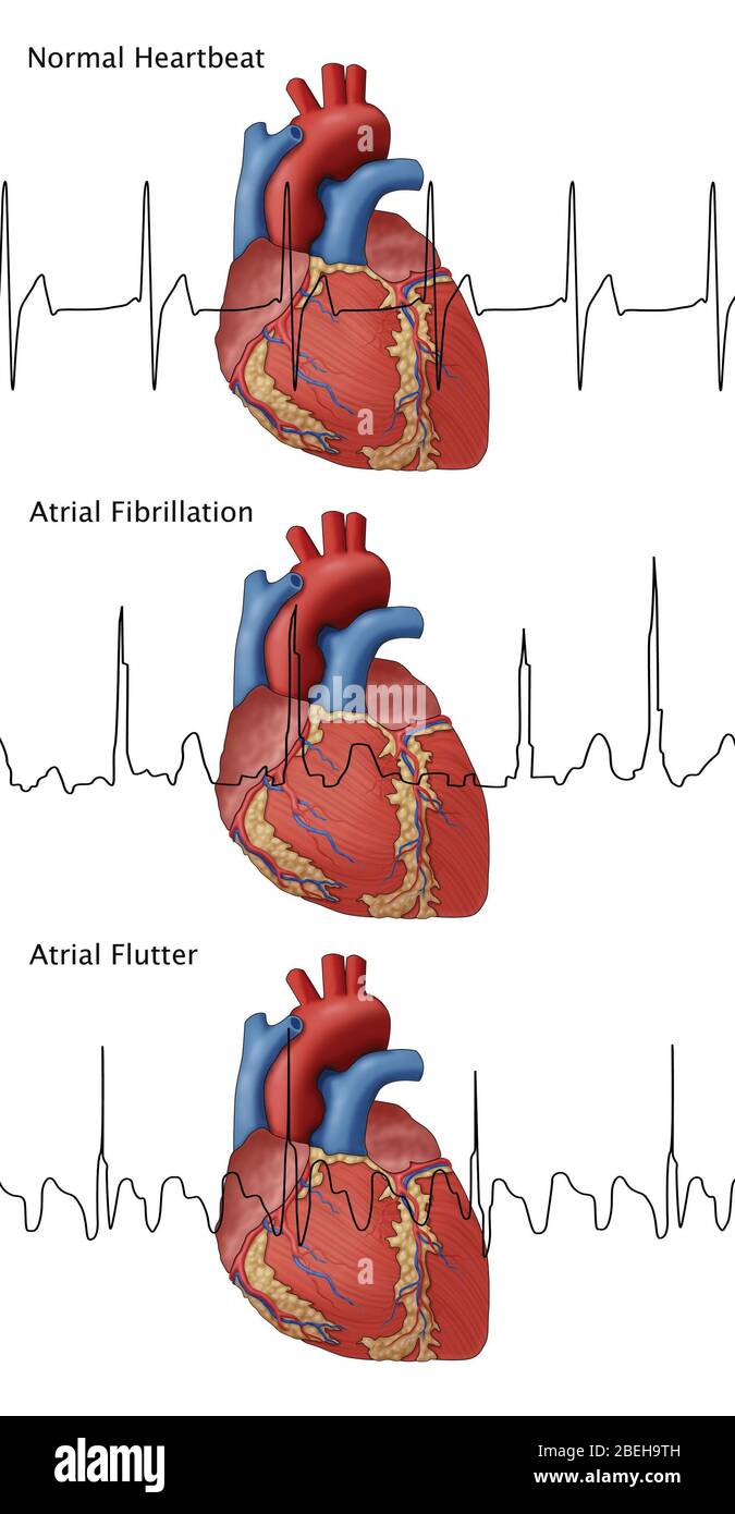 Heartbeat, AFib and Atrial Flutter, Illustration Stock Photo
