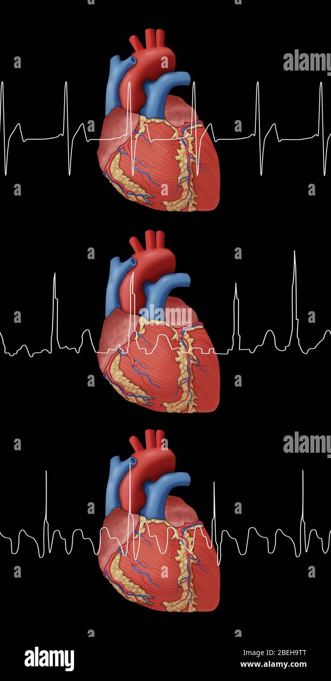 Heartbeat, AFib and Atrial Flutter, Illustration Stock Photo