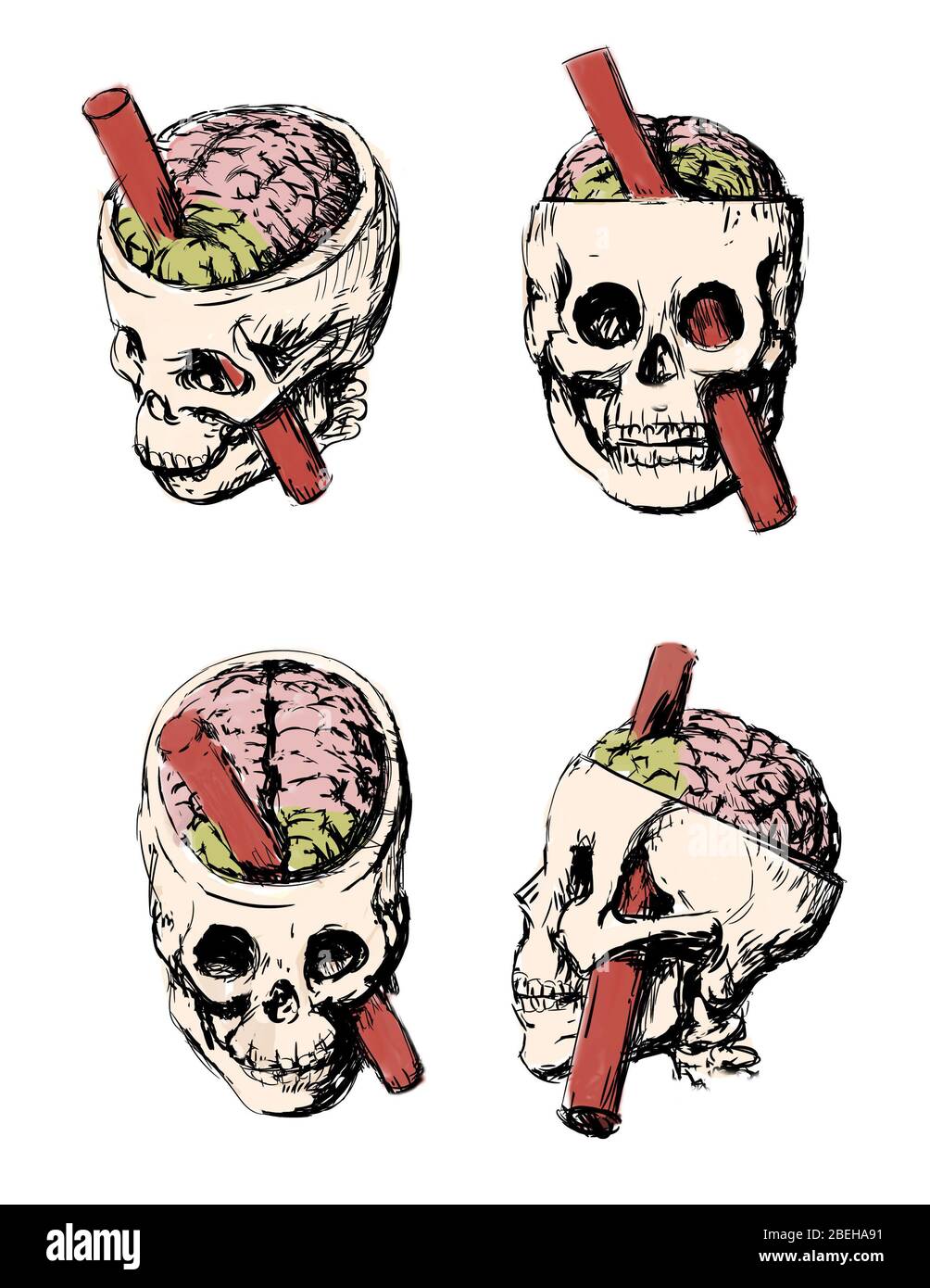 An illustration of the brain injury of Phineas Gage. Phineas P. Gage, 1823-1860, was an American railroad worker who survived an accident in 1848 in which a large iron rod was driven through his head. The iron rod destroyed most of his left frontal lobe. The effects of the injury on his personality have been much debated as there is scant written evidence of what his behavior actually was for the twelve remaining years of his life. Stock Photo