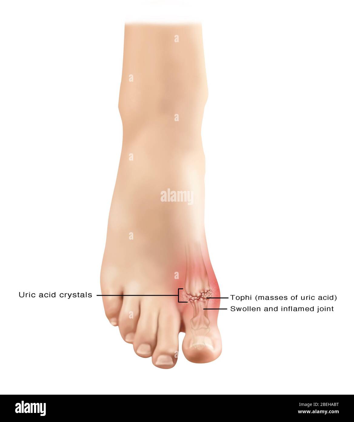 Gout in Foot, Illustration Stock Photo