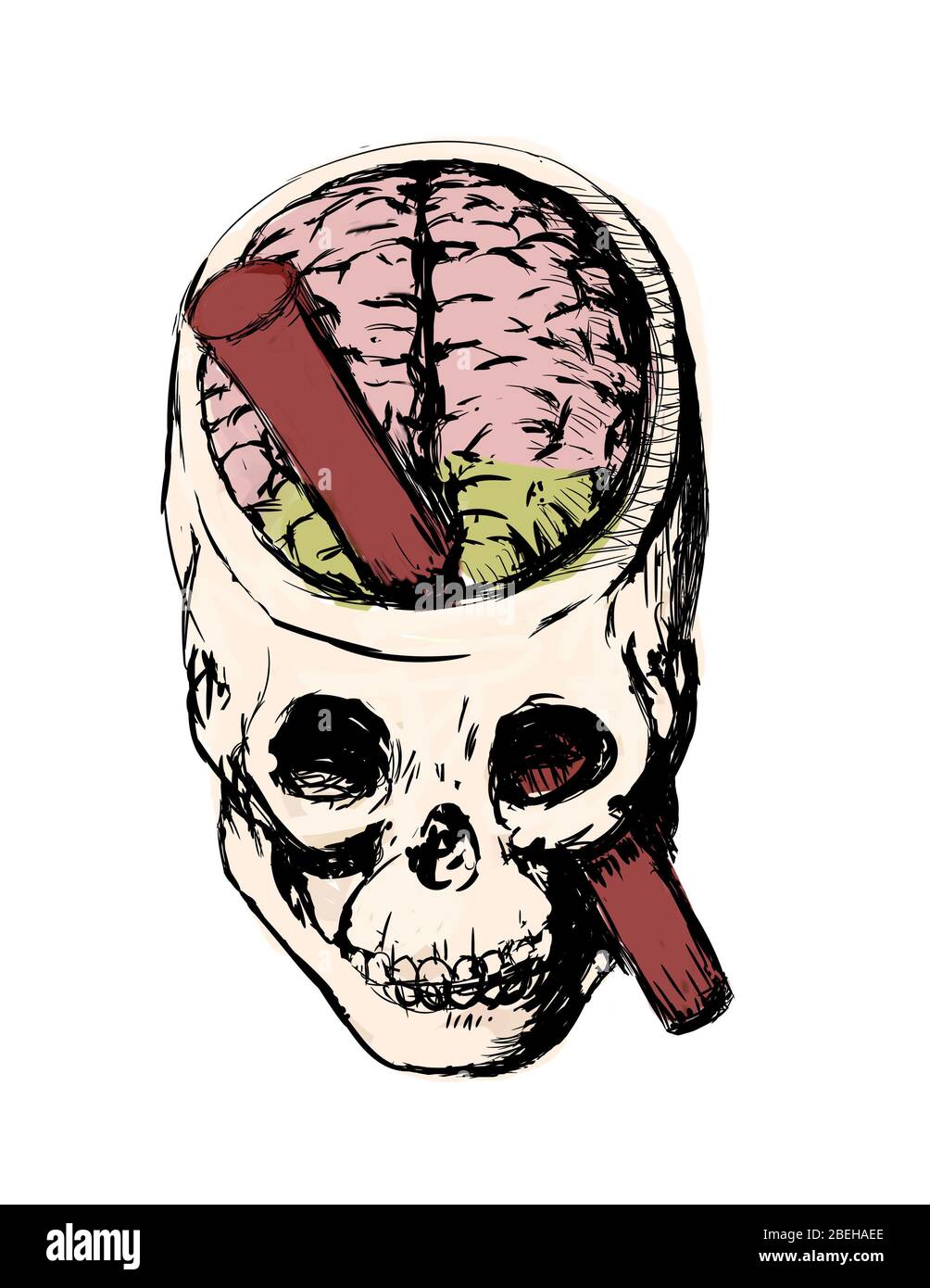 An illustration of the brain injury of Phineas Gage. Phineas P. Gage, 1823-1860, was an American railroad worker who survived an accident in 1848 in which a large iron rod was driven through his head. The iron rod destroyed most of his left frontal lobe. The effects of the injury on his personality have been much debated as there is scant written evidence of what his behavior actually was for the twelve remaining years of his life. Stock Photo