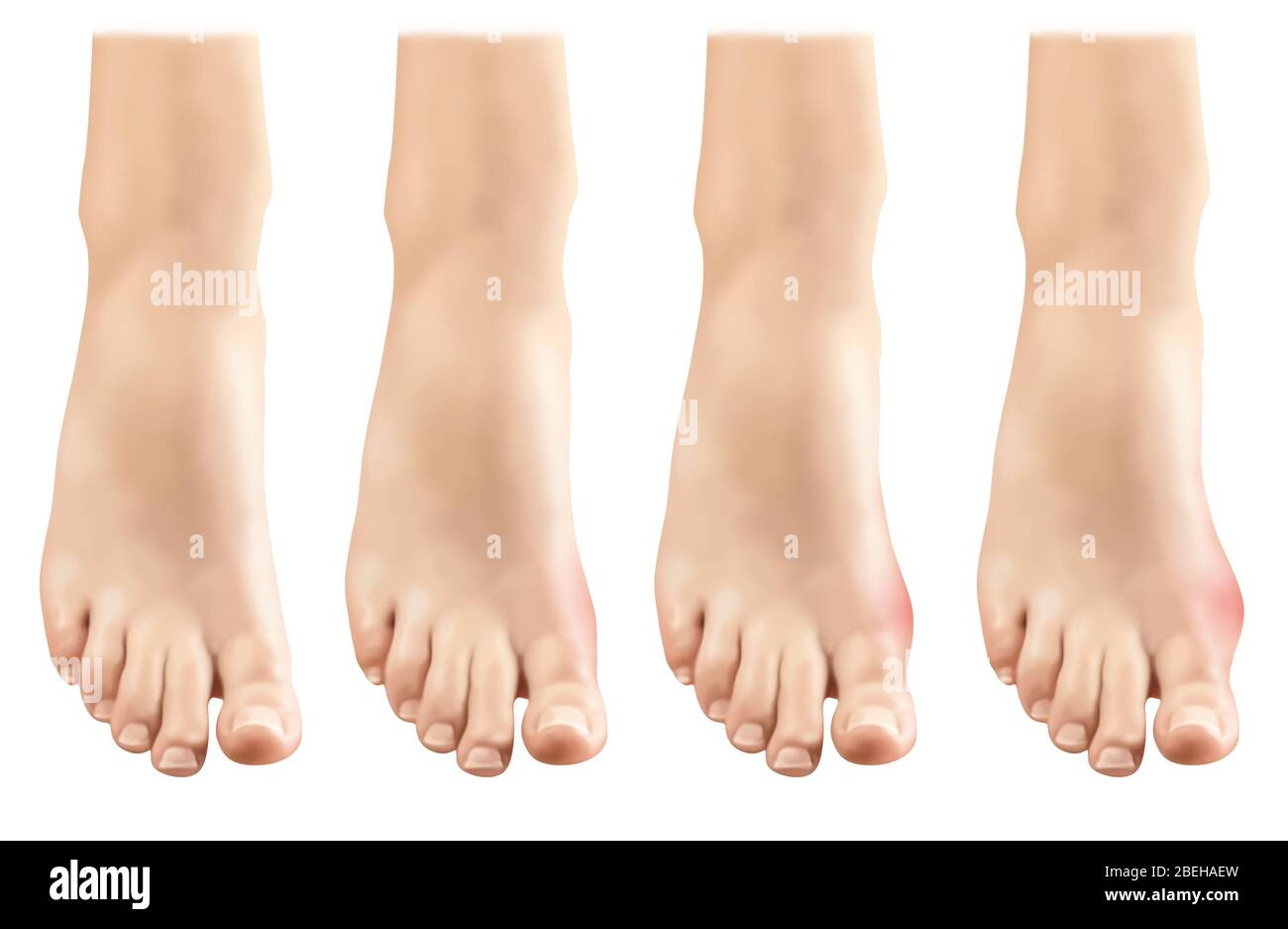 Gout in Foot, Illustration Stock Photo