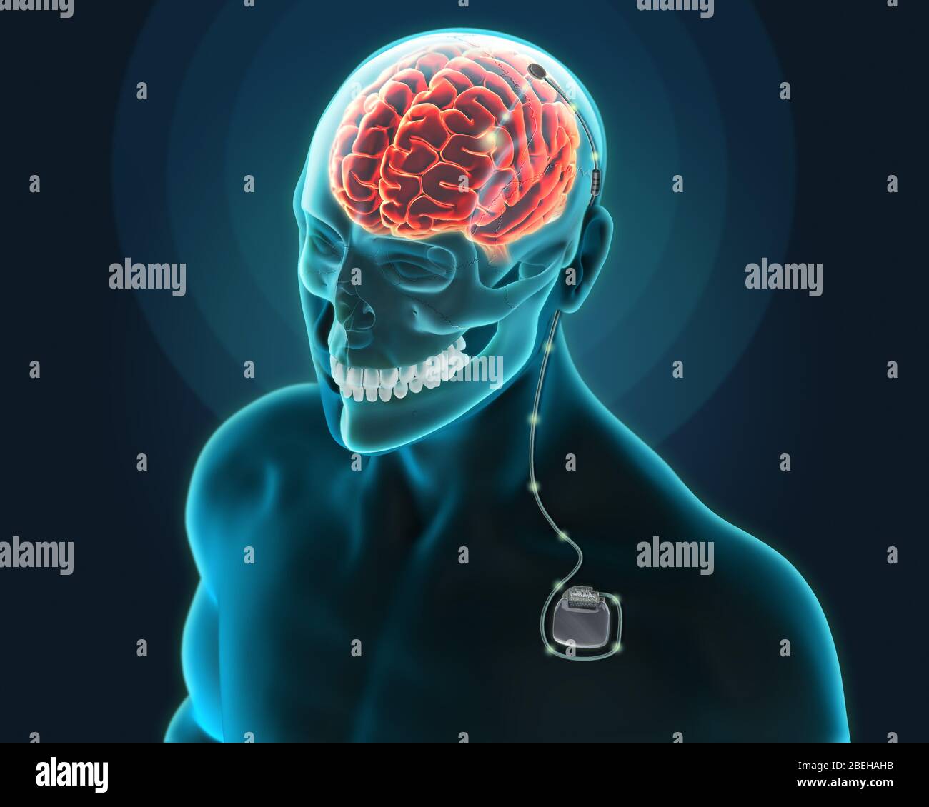 Deep Brain Stimulation, Illustration Stock Photo