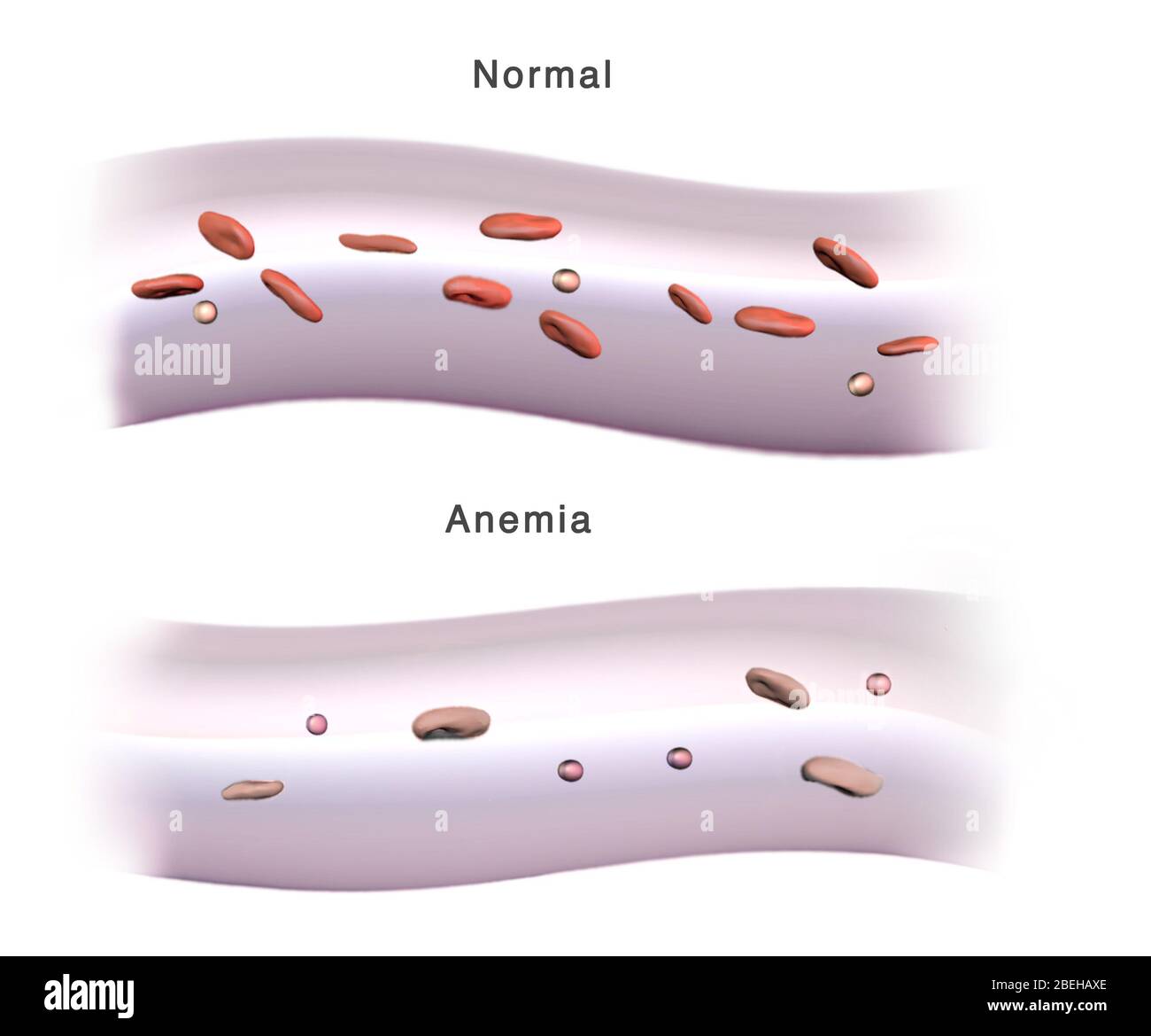 Red Blood Cells and Anemia, Illustration Stock Photo