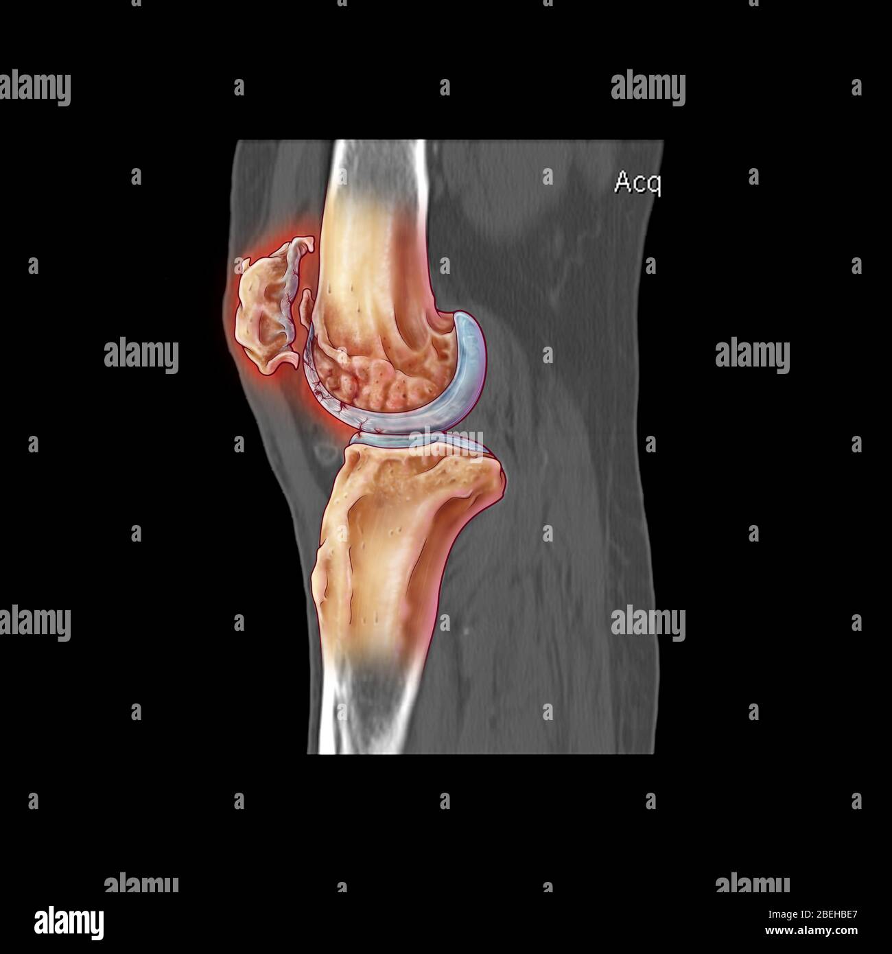 Osteoporosis Of Knee Human Anatomy