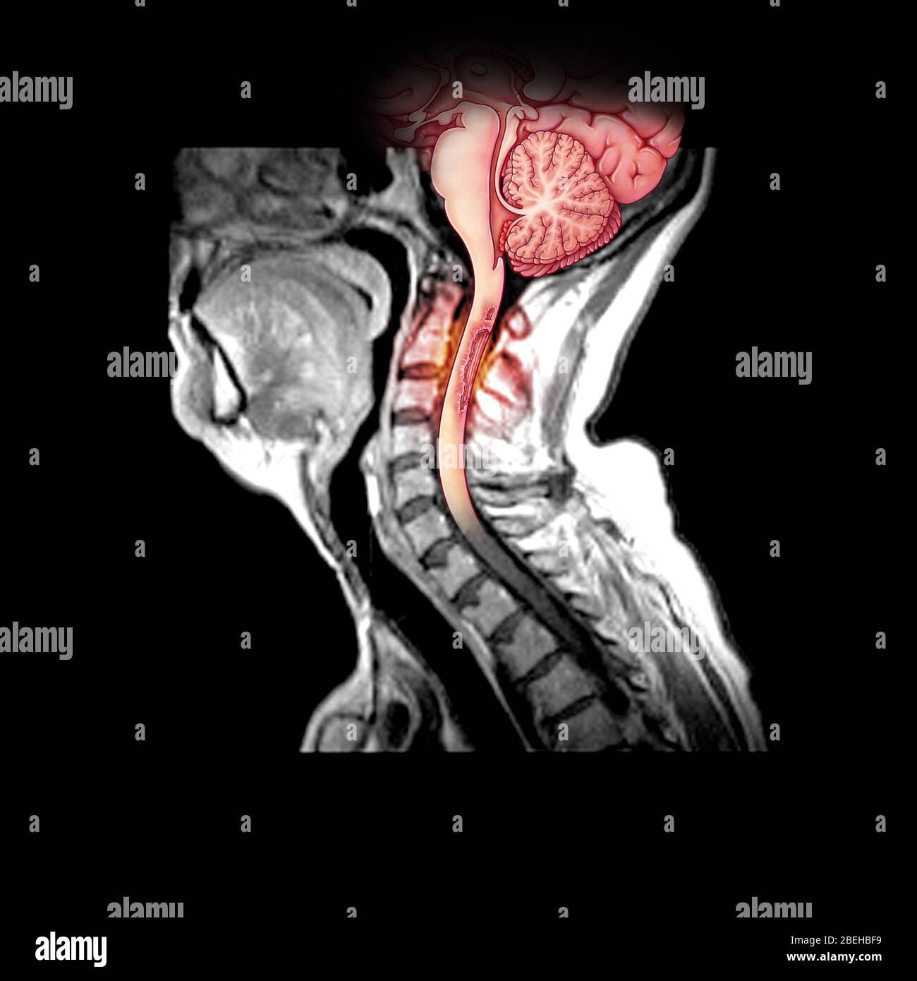 Demyelination of Spinal Cord in MS Stock Photo