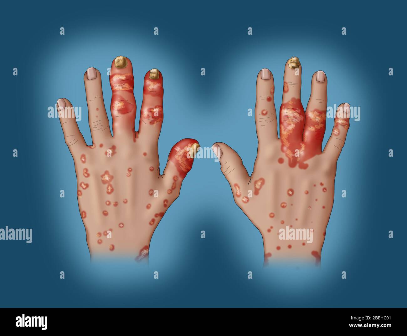 Psoriatic nails hi-res stock photography and images - Alamy Psoriatic nails hi-res stock photography and images - Alamy