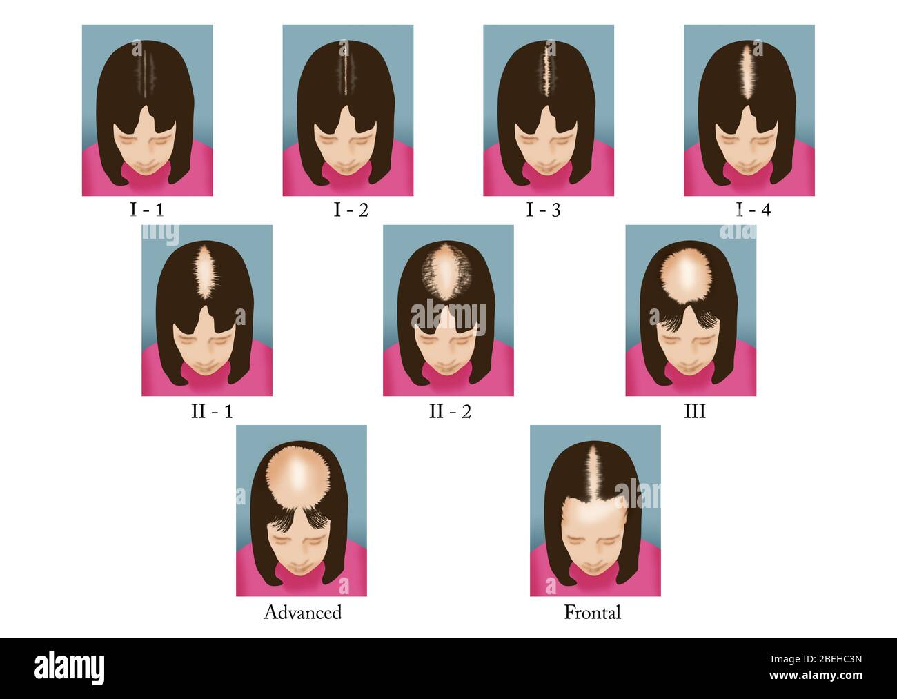 The Ludwig pattern of hair loss (3-point). There are three main... |  Download Scientific Diagram