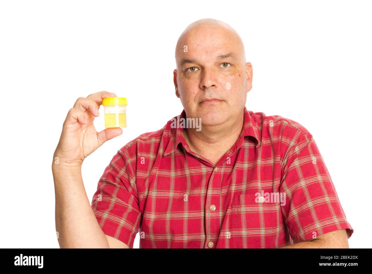 A guy holding a urine sample on white, bald from chemotherapy. Stock Photo