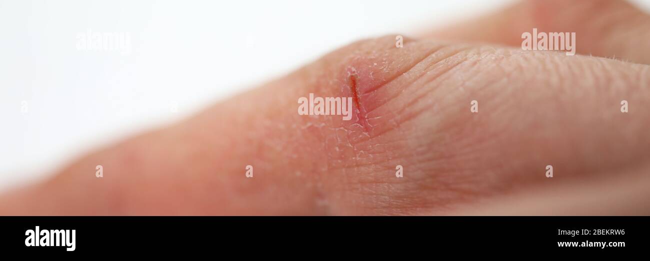 Open Wounded Finger Close-up small wound on finger, dry skin hands Stock Photo - Alamy