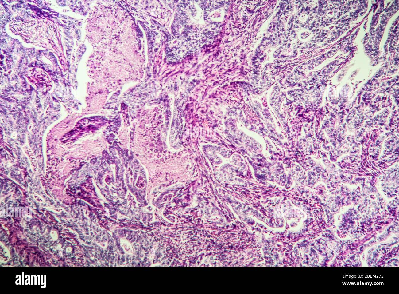 Gastric carcinoma in tissue section 100x Stock Photo - Alamy