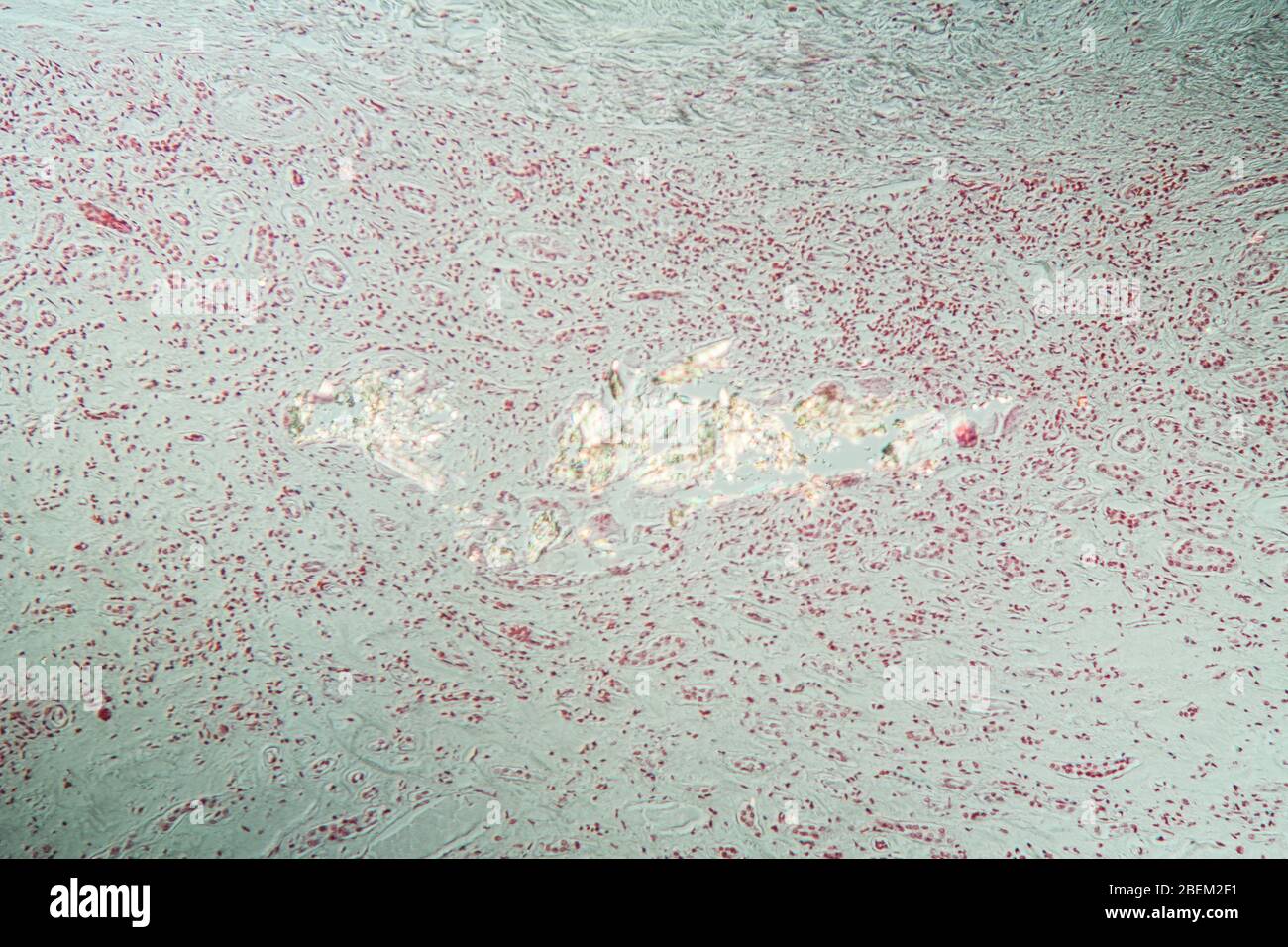 Gout crystals deposits in the kidney tissue under the microscope 100x Stock  Photo - Alamy, image size:1300x956