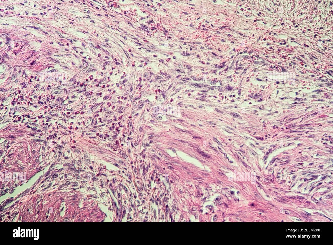 Gallbladder necrosis tissue under the microscope 100x Stock Photo