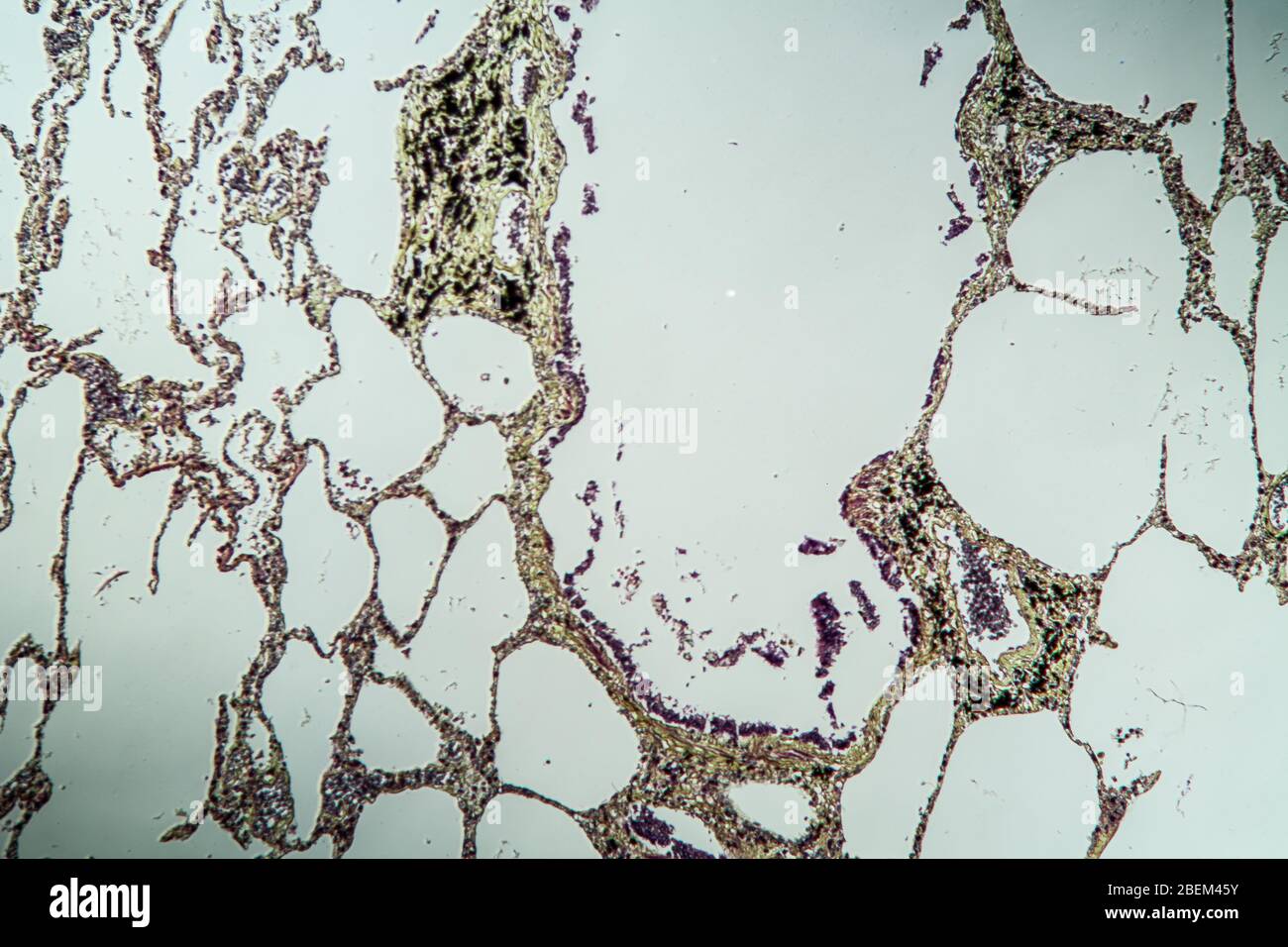 Asthma der Lunge krankes Gewebe unter dem Mikroskop 100x Stock Photo