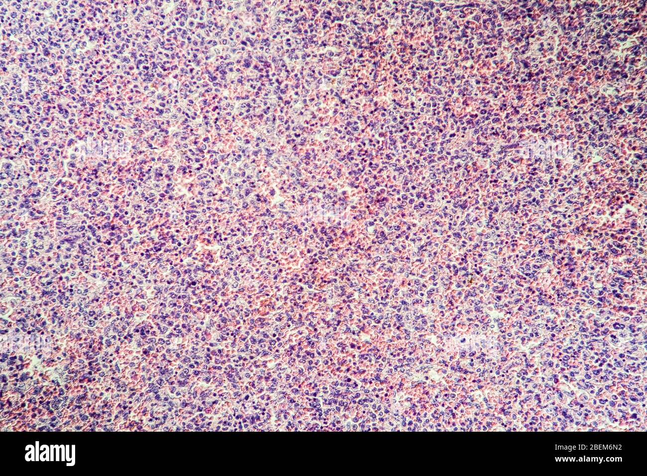 Gas burn of the liver diseased tissue under the microscope 100x Stock Photo