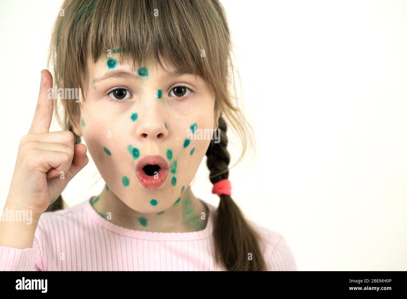 Child girl covered with green rashes on face ill with chickenpox, measles or rubella virus. Stock Photo