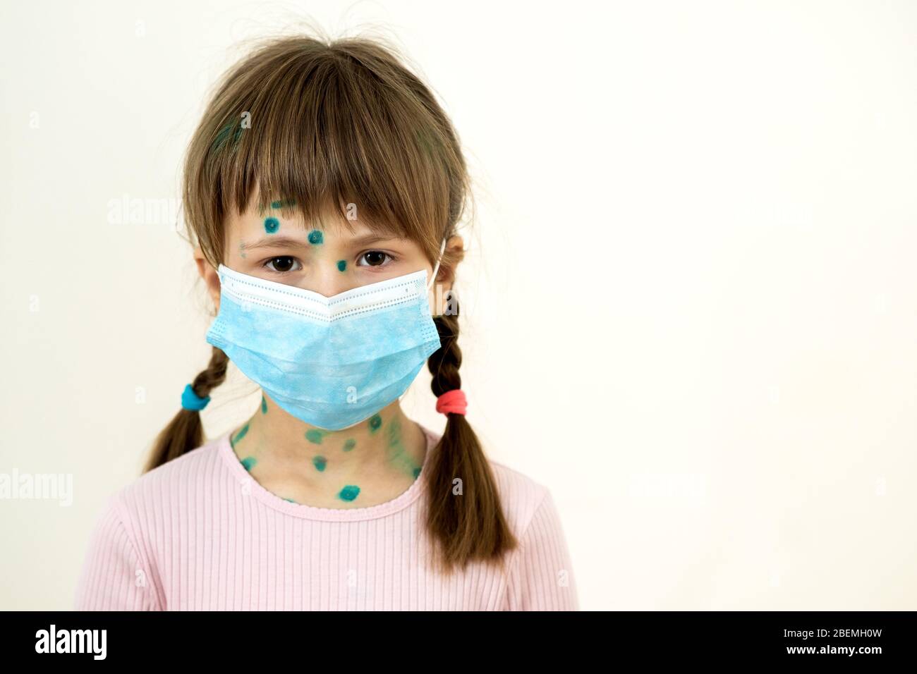 Child girl wearing blue protective medical mask ill with chickenpox, measles or rubella virus with rashes on body. Children protection during epidemic Stock Photo