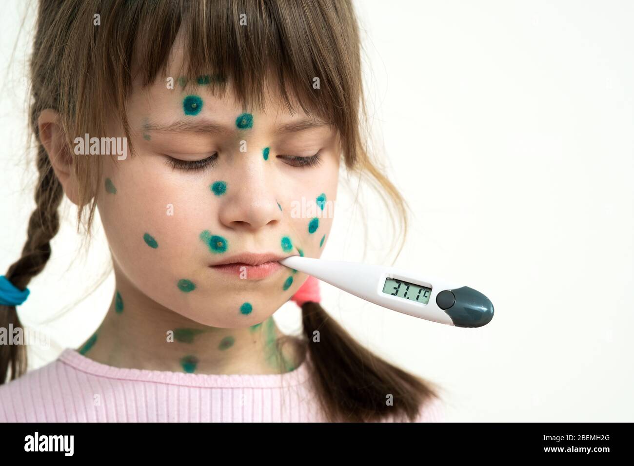 Child girl covered with green rashes on face ill with chickenpox, measles or rubella virus holding medical thermometer in her mouth having high temper Stock Photo