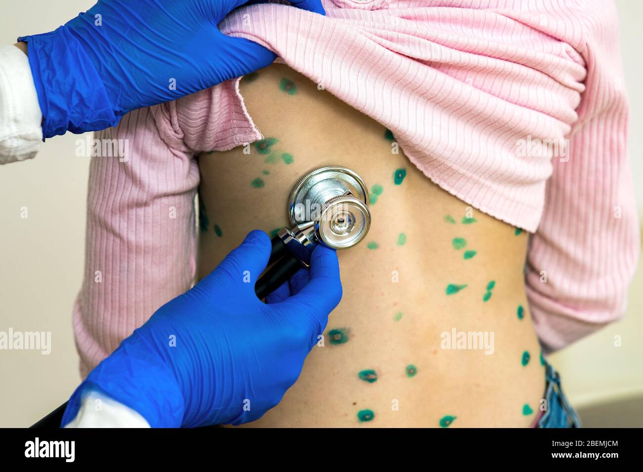 Doctor examining a child with stethoscope covered with green rashes on back ill with chickenpox, measles or rubella virus. Stock Photo