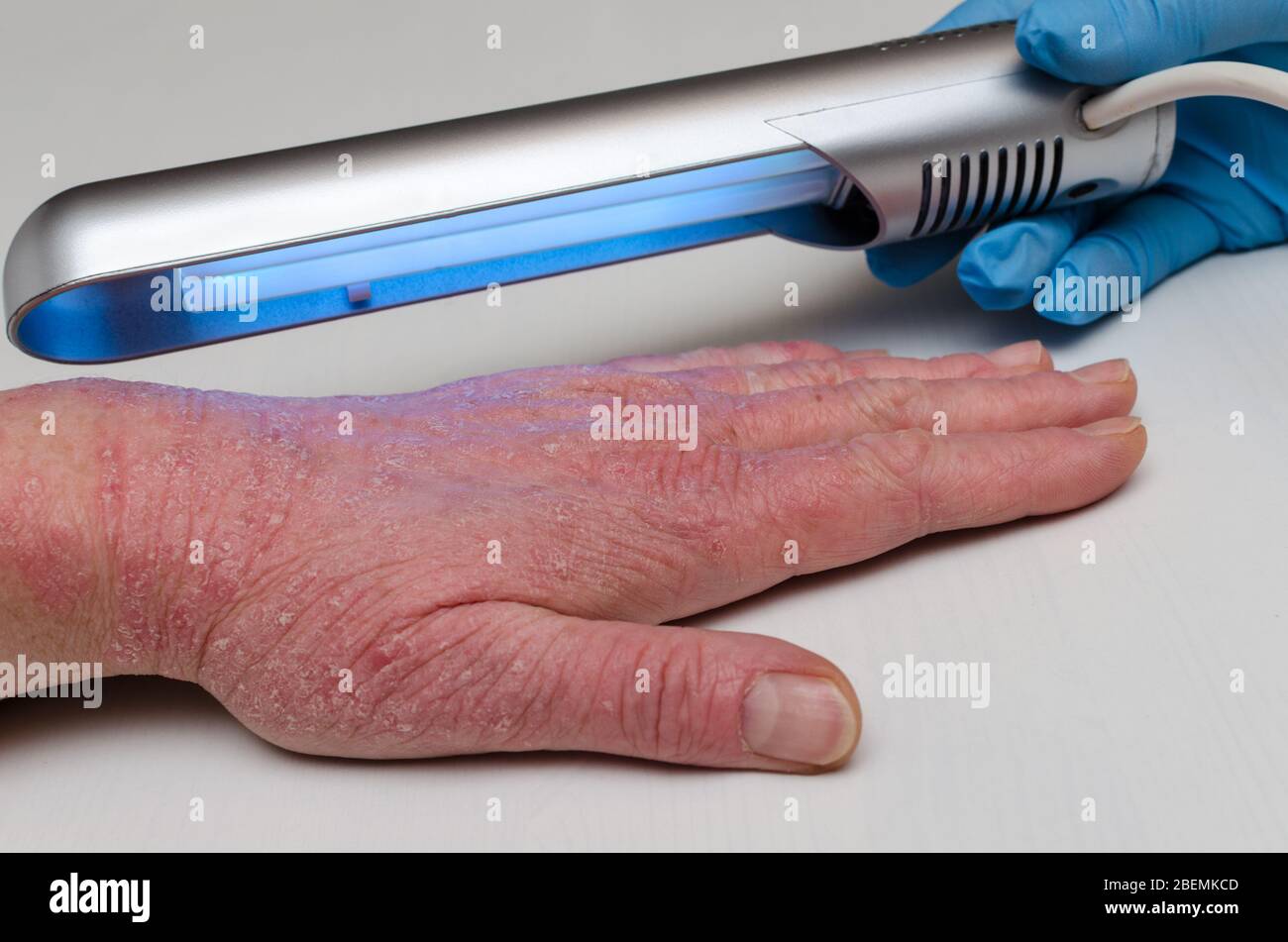 Treatment of skin diseases with narrow-band ultraviolet with a wavelength of 311 nm Stock Photo