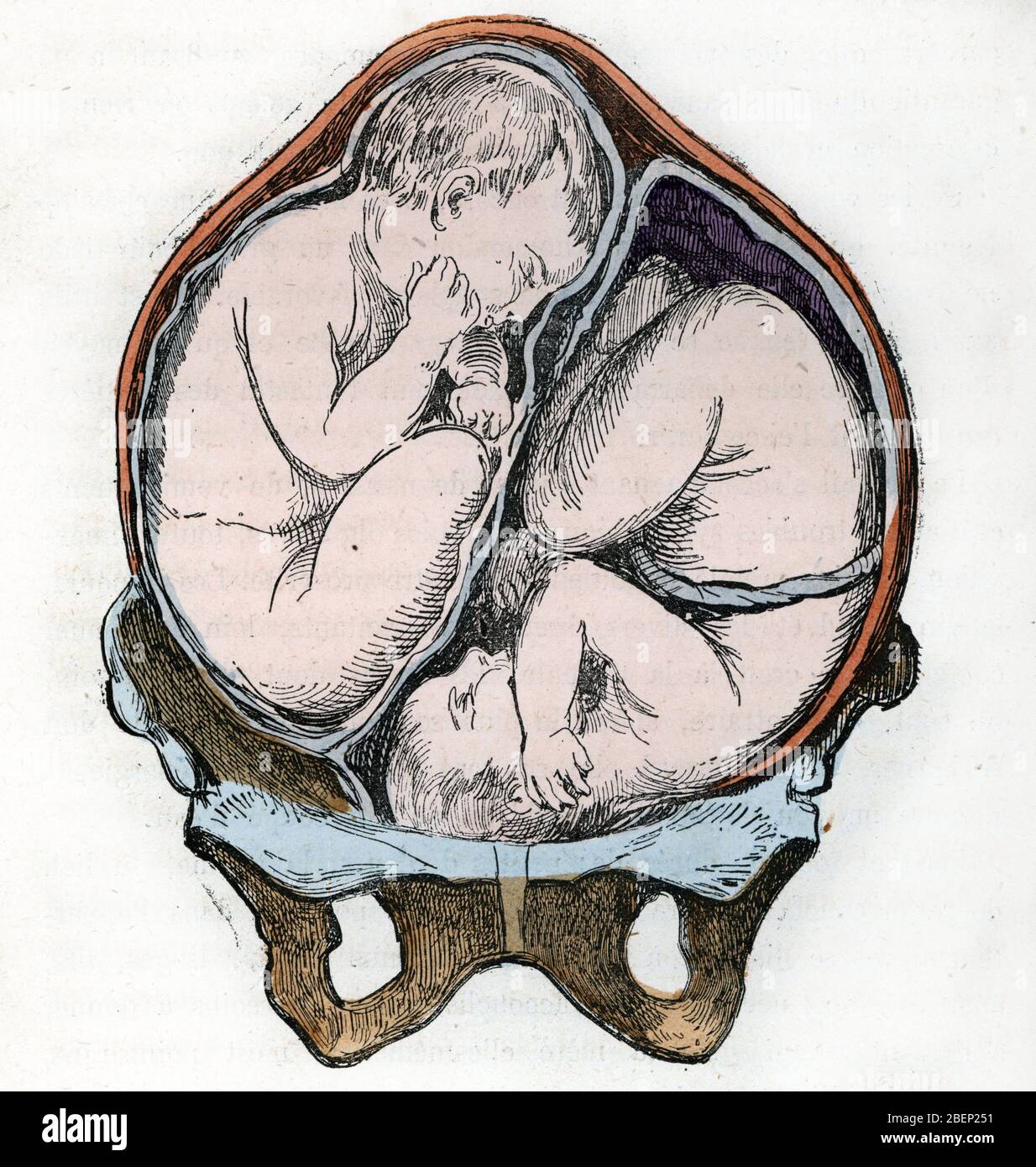 Representation de la bonne position de deux foetus lors d'une grossesse gemellaire (Representation of the good position of two fetuses during a gemell Stock Photo