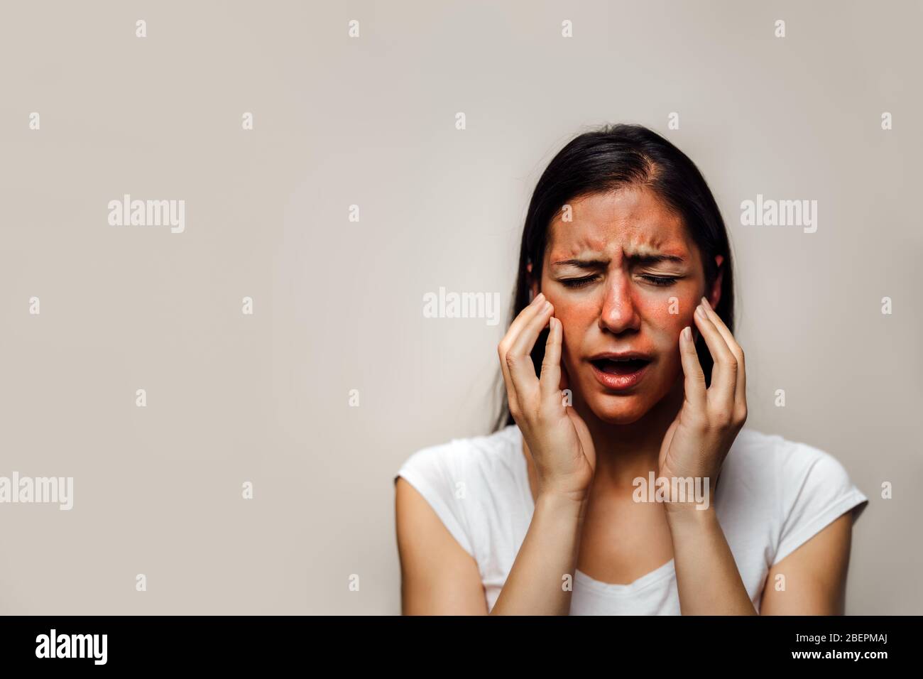 Woman with painful hot sunburn,facial skin redness problem,photosensitivity.Chemical burn,allergic reaction.Rosacea,dermatological condition,eczema.Ta Stock Photo