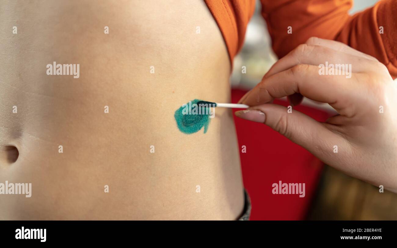 Shingles rash on hand hi-res stock photography and images - Alamy