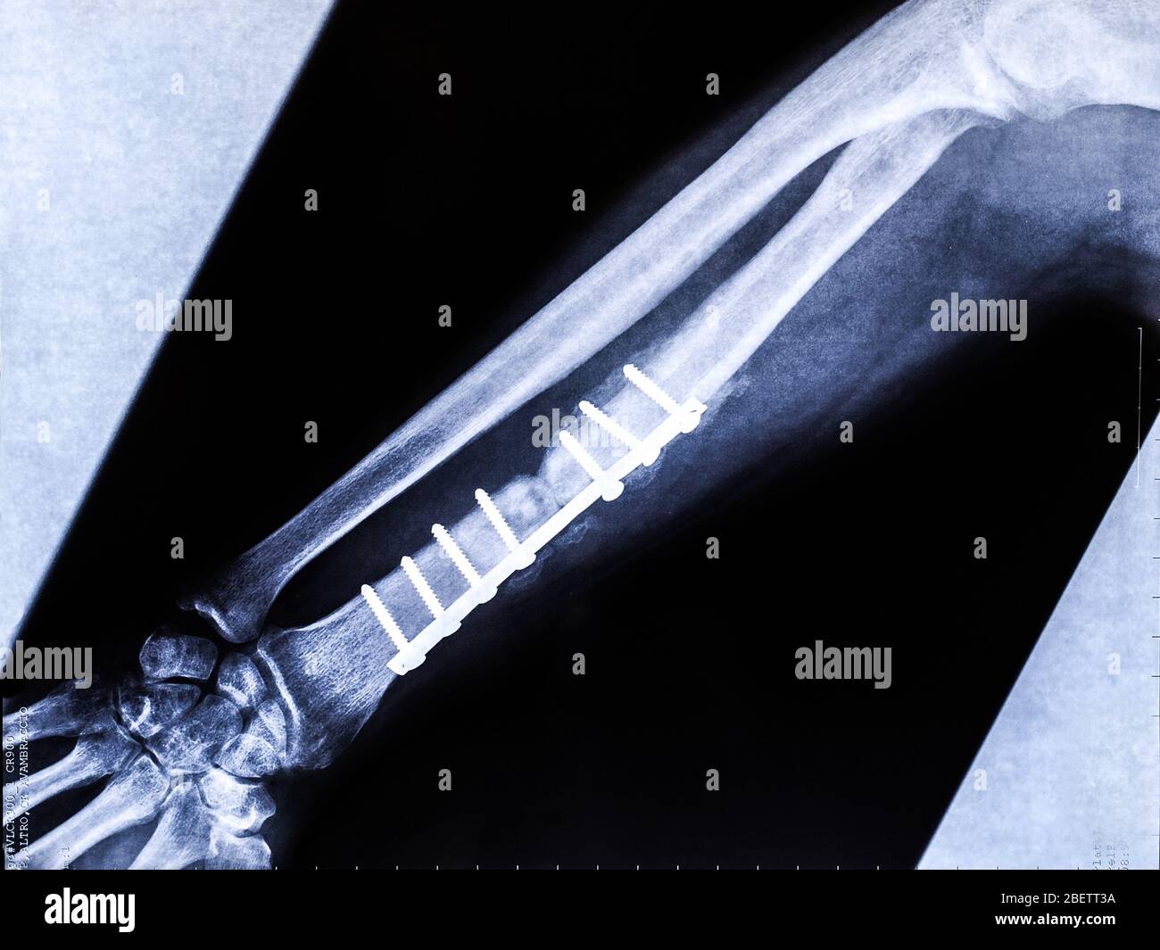 Titanium plate on radius bone in a diagnostic radiograph post surgical operation Stock Photo