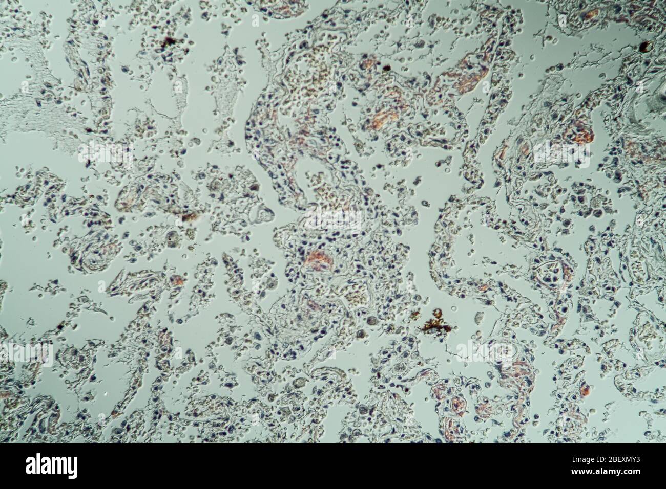Lungs with amyloid deposits of sick tissue under the microscope 200x ...