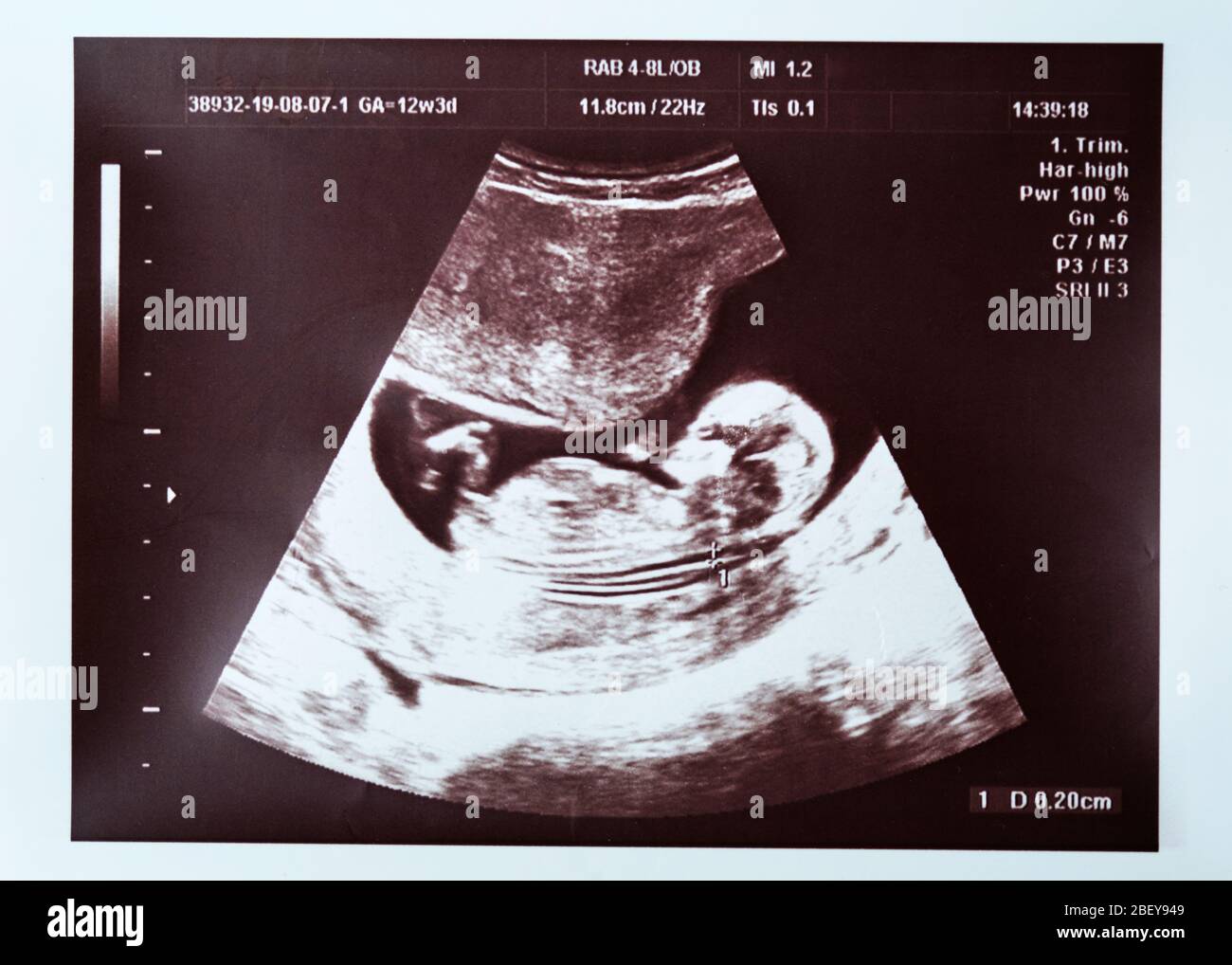 Scan at weeks pregnancy 4 You and