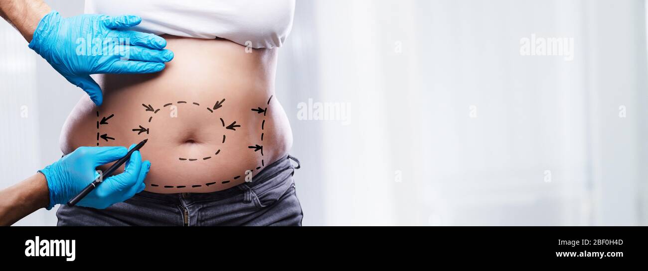 Abdominoplasty surgery hi-res stock photography and images - Alamy