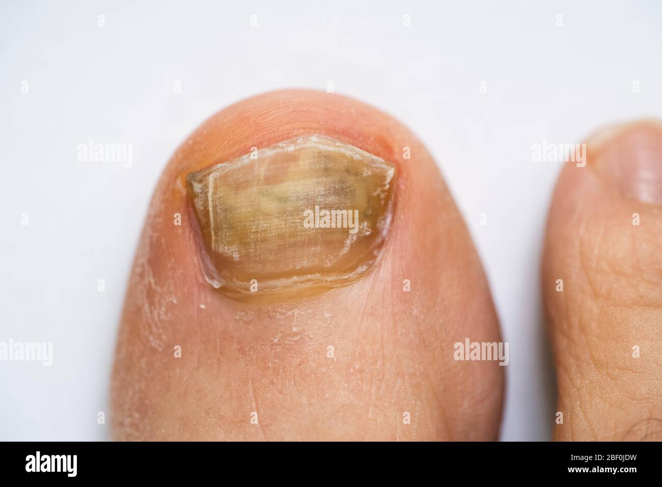 Broken Male Foot Nail And Fungal Infection Stock Photo