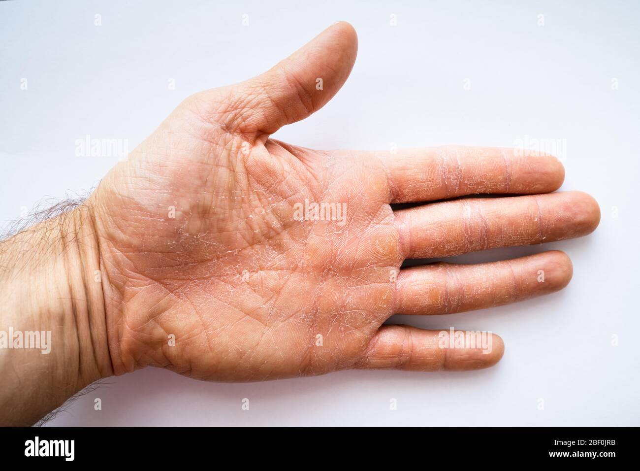 Dry Man Hand With Skin Peeling Off Stock Photo - Alamy