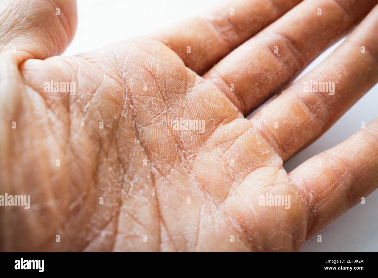 Dry Man Hand With Skin Peeling Off Stock Photo