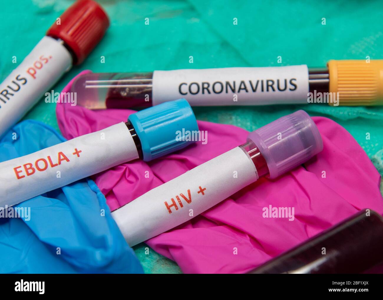 Tube with blood and positive test at HIV. and Ebola Stock Photo